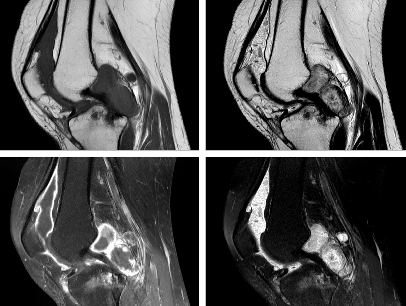 Figure 2 for case chronic synovitis